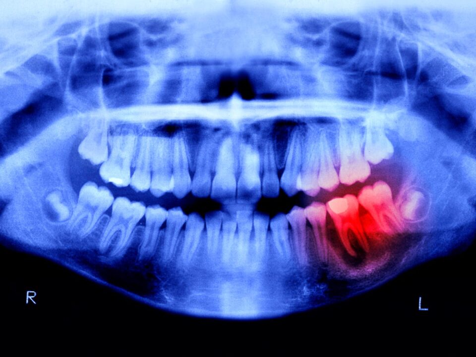 در حالی که استخوان‌های بدن انسان توانایی ترمیم و بازسازی پس از شکستگی را دارند، دندان‌ها از این قابلیت محروم‌اند و همین موضوع باعث شده میلیون‌ها نفر در سراسر جهان با مشکل بی‌دندانی مواجه شوند. اما این وضعیت ممکن است به‌زودی تغییر کند. پژوهشگران ژاپنی از آزمایش دارویی خبر داده‌اند که می‌تواند رشد مجدد دندان‌های انسان را ممکن سازد؛ پیشرفتی که در صورت موفقیت، تا حدود سال ۲۰۳۰ به یک درمان عملی تبدیل خواهد شد. دندان‌ها اگرچه از سخت‌ترین مواد بدن ساخته شده‌اند و مینای دندان آن‌ها را به‌خوبی محافظت می‌کند، اما برخلاف استخوان‌ها توانایی ترمیم طبیعی ندارند. محققان ژاپنی سال‌هاست در تلاش‌اند این محدودیت زیستی را پشت سر بگذارند. نتیجه این تلاش‌ها، تمرکز بر آنتی‌بادی ویژه‌ای به نام USAG-1 بوده که نقش مهارکننده‌ای در رشد دندان دارد. در سال ۲۰۲۱، دانشمندان دانشگاه کیوتو موفق شدند یک آنتی‌بادی مونوکلونال شناسایی کنند که تعامل میان USAG-1 و پروتئین‌های مورفوژنتیک استخوان (BMP) را مختل می‌کند؛ پروتئین‌هایی که در رشد استخوان و دندان نقش کلیدی دارند. سرکوب این ژن در آزمایش‌های حیوانی، منجر به رشد دندان‌های جدید در موش‌ها و خرگوش‌های صحرایی شد؛ حیواناتی که الگوی دندانی آن‌ها شباهت زیادی به انسان دارد. کاتسو تاکاهشی، رئیس بخش دندان‌پزشکی مؤسسه تحقیقات پزشکی بیمارستان کیتانو در اوساکا، درباره این پروژه می‌گوید: «ما می‌خواهیم به افرادی که از فقدان دندان رنج می‌برند کمک کنیم. تاکنون هیچ درمان دائمی برای این مشکل وجود نداشته، اما انتظار مردم برای امکان رشد دوباره دندان‌ها بسیار بالاست.» اکنون این پژوهش وارد مرحله آزمایش انسانی شده است. مطالعه‌ای ۱۱ ماهه روی ۳۰ مرد بین ۳۰ تا ۶۴ سال که حداقل یک دندان از دست داده‌اند، در حال انجام است. دارو به‌صورت تزریق وریدی استفاده می‌شود تا ایمنی و اثربخشی آن بررسی شود. نکته امیدوارکننده این است که در مطالعات حیوانی پیشین، هیچ عارضه جانبی جدی گزارش نشده است. در صورت موفقیت این مرحله، مرحله بعدی درمان کودکان ۲ تا ۷ ساله‌ای خواهد بود که به‌صورت مادرزادی حداقل چهار دندان ندارند. هدف نهایی پژوهشگران، ارائه رسمی داروی رشد دندان تا سال ۲۰۳۰ است. هرچند تمرکز اولیه بر بیماران دارای کمبود دندان مادرزادی است، اما تاکاهشی امیدوار است این درمان در آینده برای همه افرادی که دندان‌های خود را از دست داده‌اند، قابل استفاده باشد. این دستاورد می‌تواند انقلابی در دندان‌پزشکی مدرن ایجاد کند و جایگزینی طبیعی برای ایمپلنت‌ها و پروتزهای دندانی باشد؛ تحولی که کیفیت زندگی میلیون‌ها انسان را به‌طور اساسی تغییر خواهد داد.